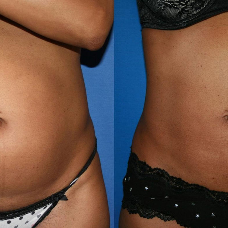 Cavitation & Laser Lipo 6 Session – Jewells Are Forever Spa